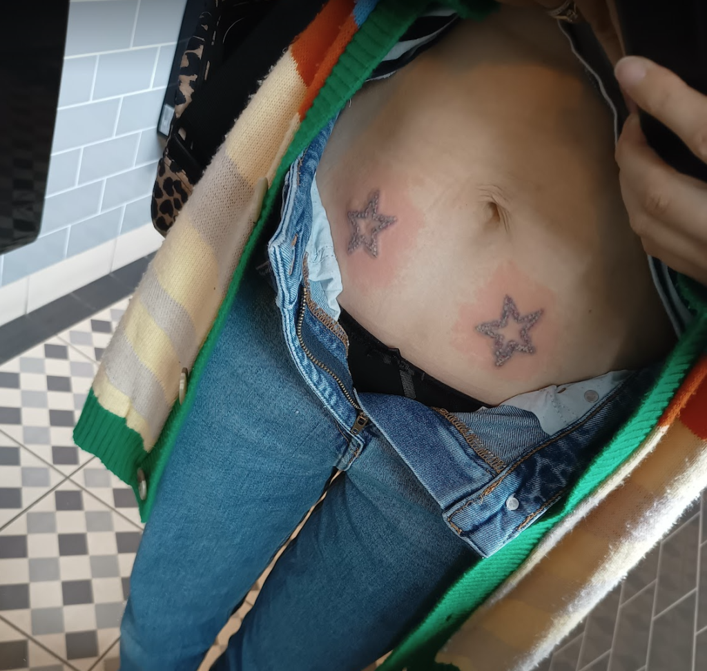 Tattoo immediately after laser removal session one.