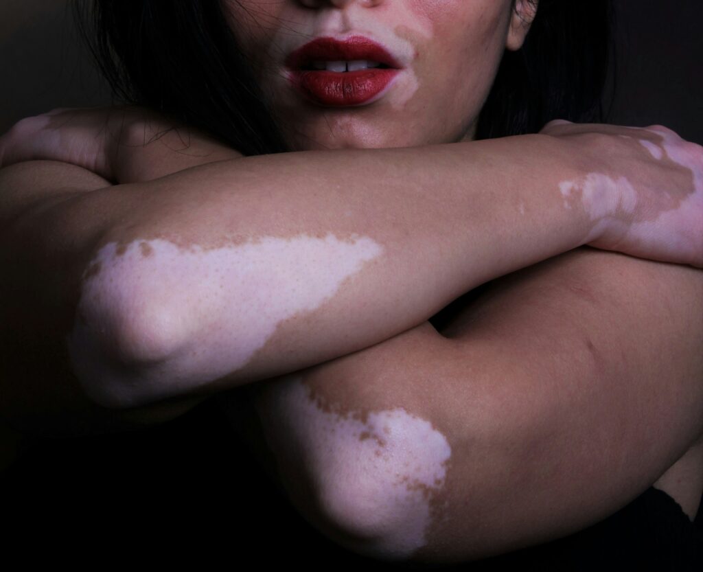 Woman with healthy skin, crossing her arms over her shoulders.